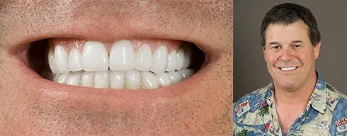 31572 teeth whitening destin fl 4