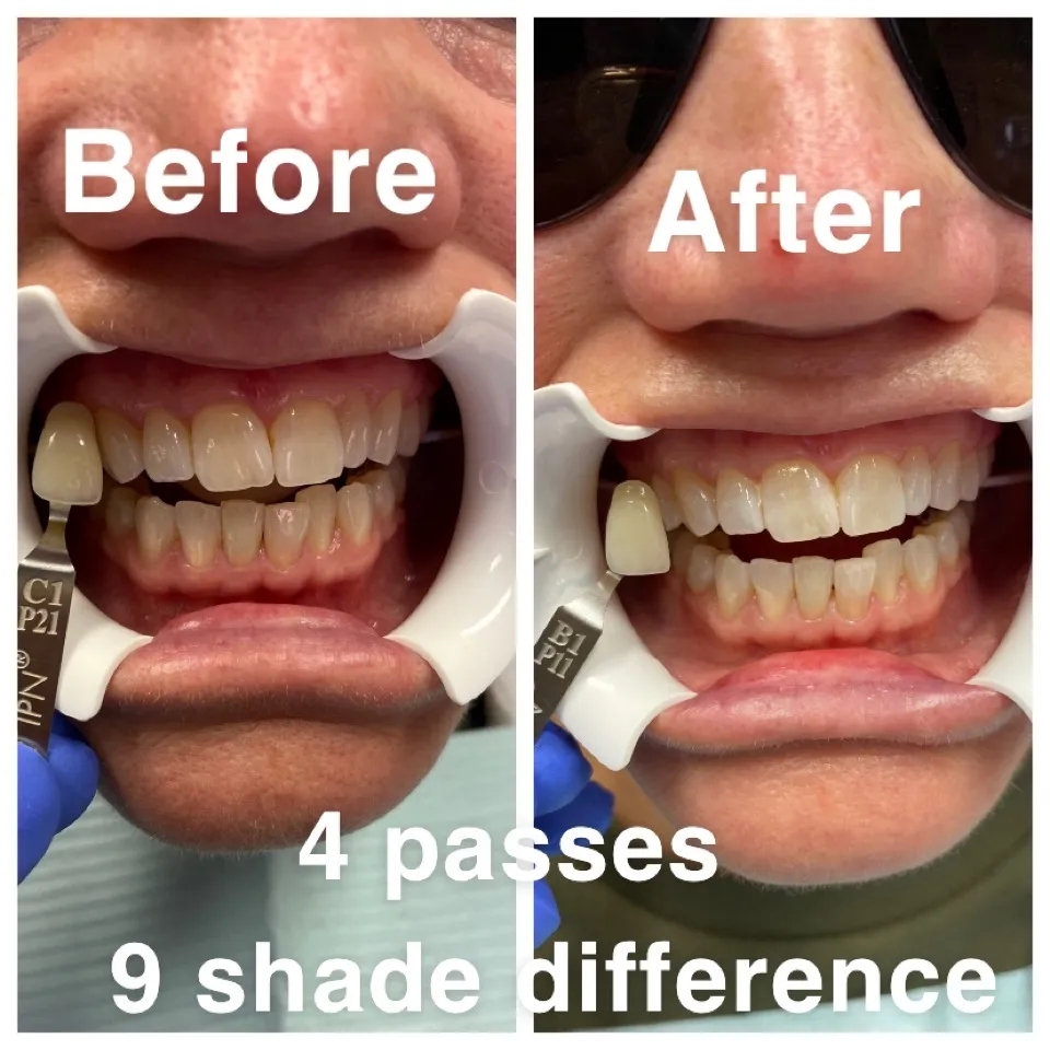 31572 teeth whitening destin fl 6
