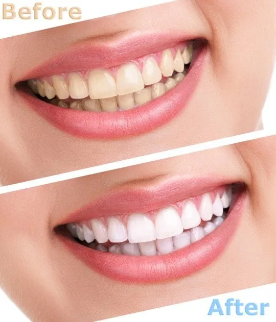 31575 whitening strips
