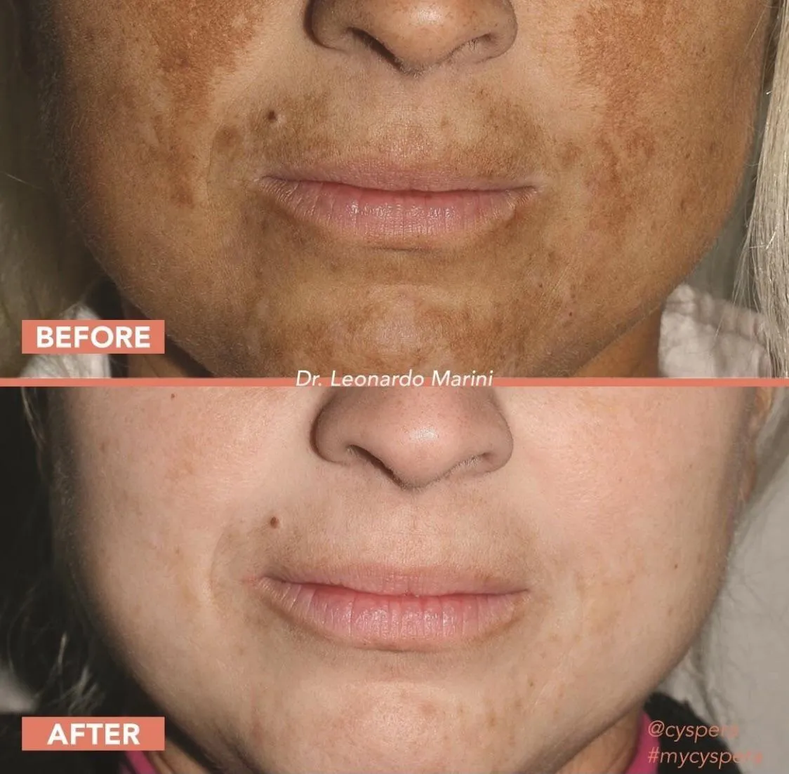 31576 exfoliation techniques