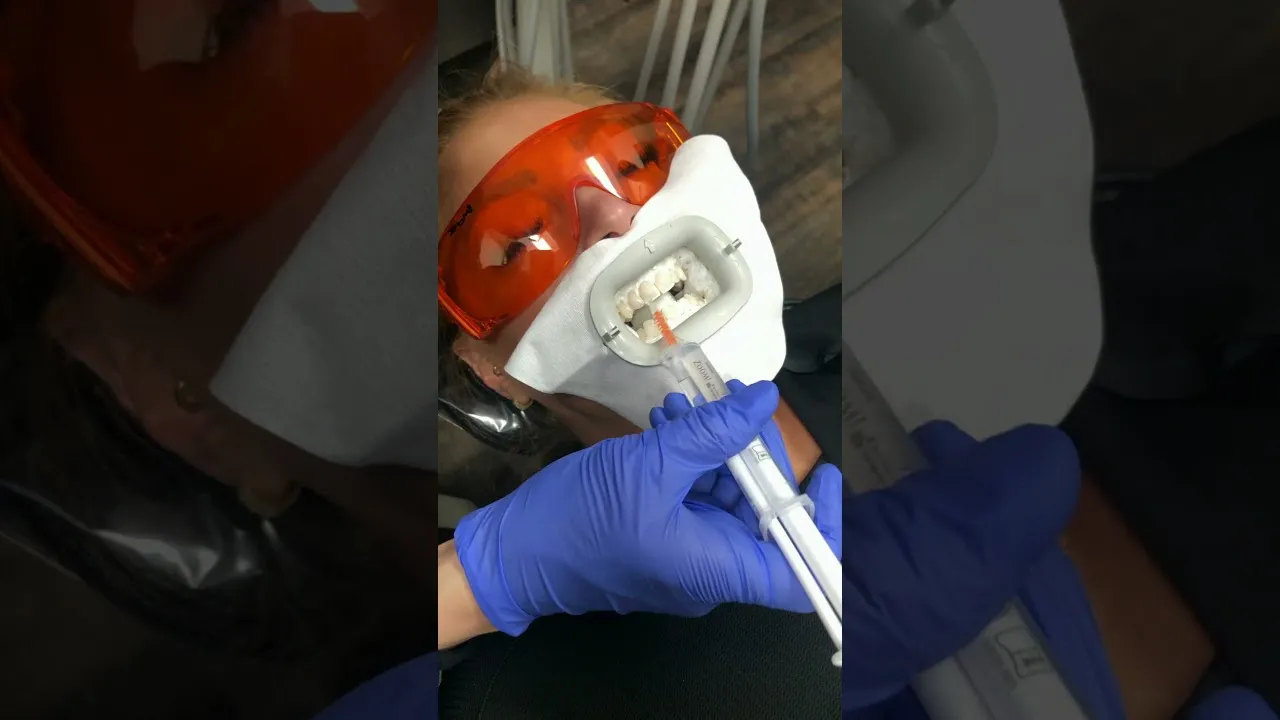 31586 zoom whitening procedure