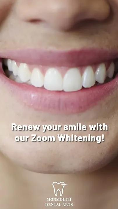 31586 zoom whitening results