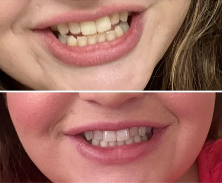 31589 snow teeth whitening kit