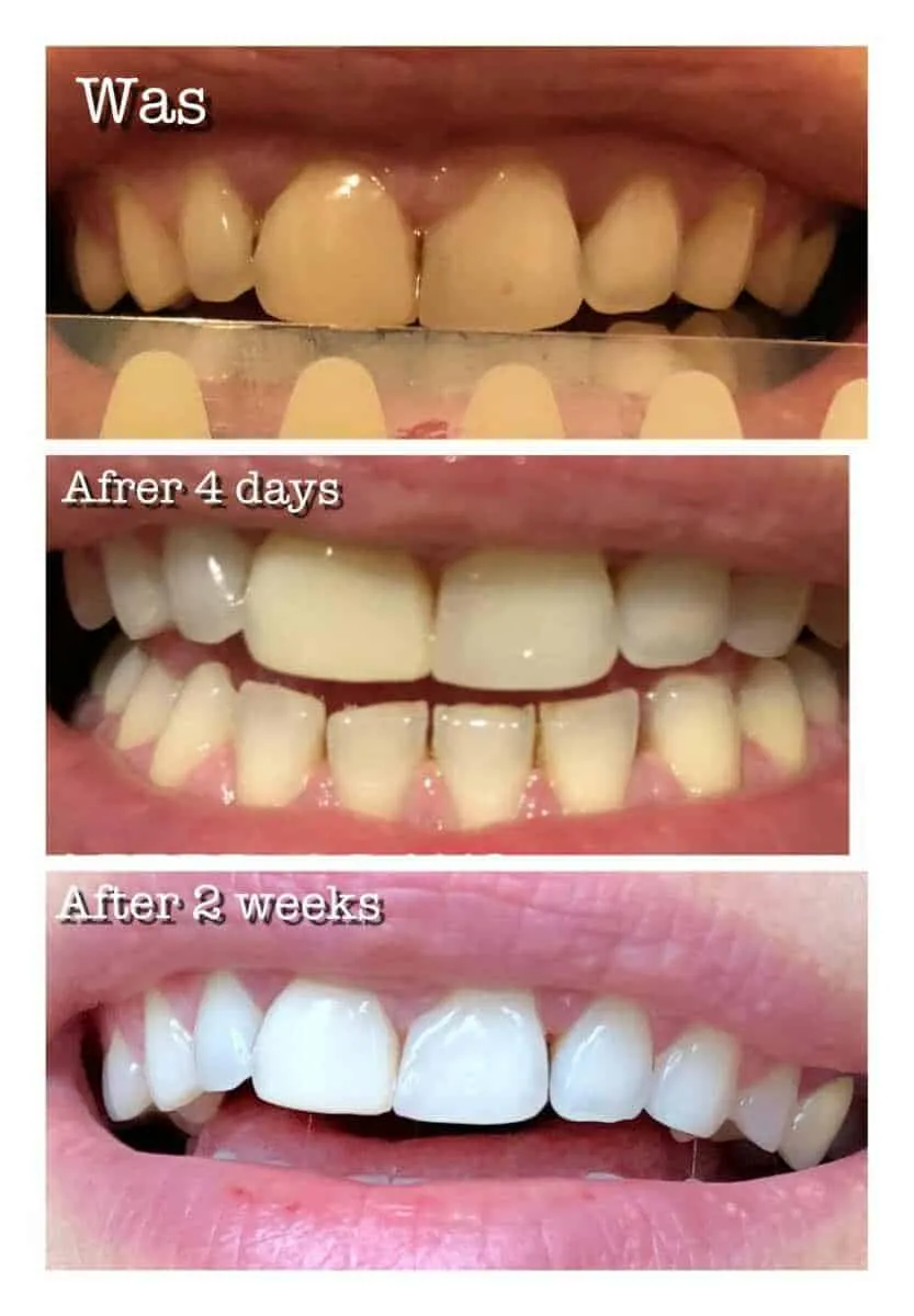 31589 teeth whitening before after
