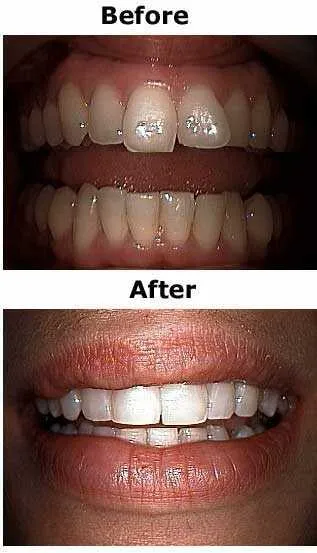 31594 at home teeth whitening