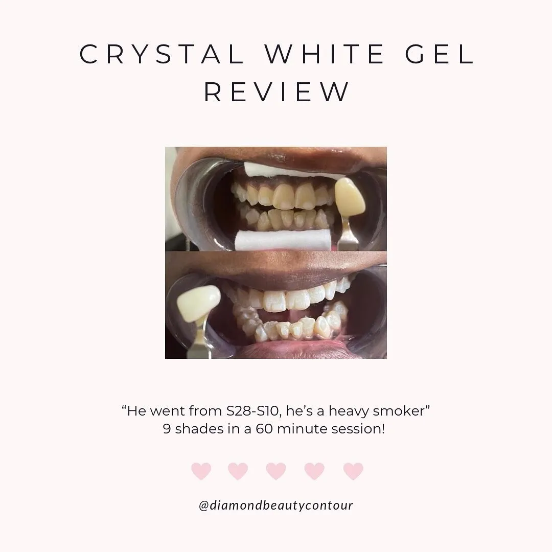 31595 teeth whitening oakville 3