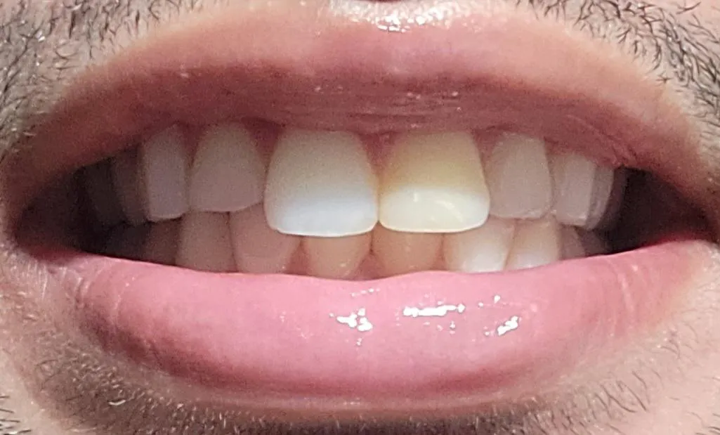 31597 diy teeth whitening