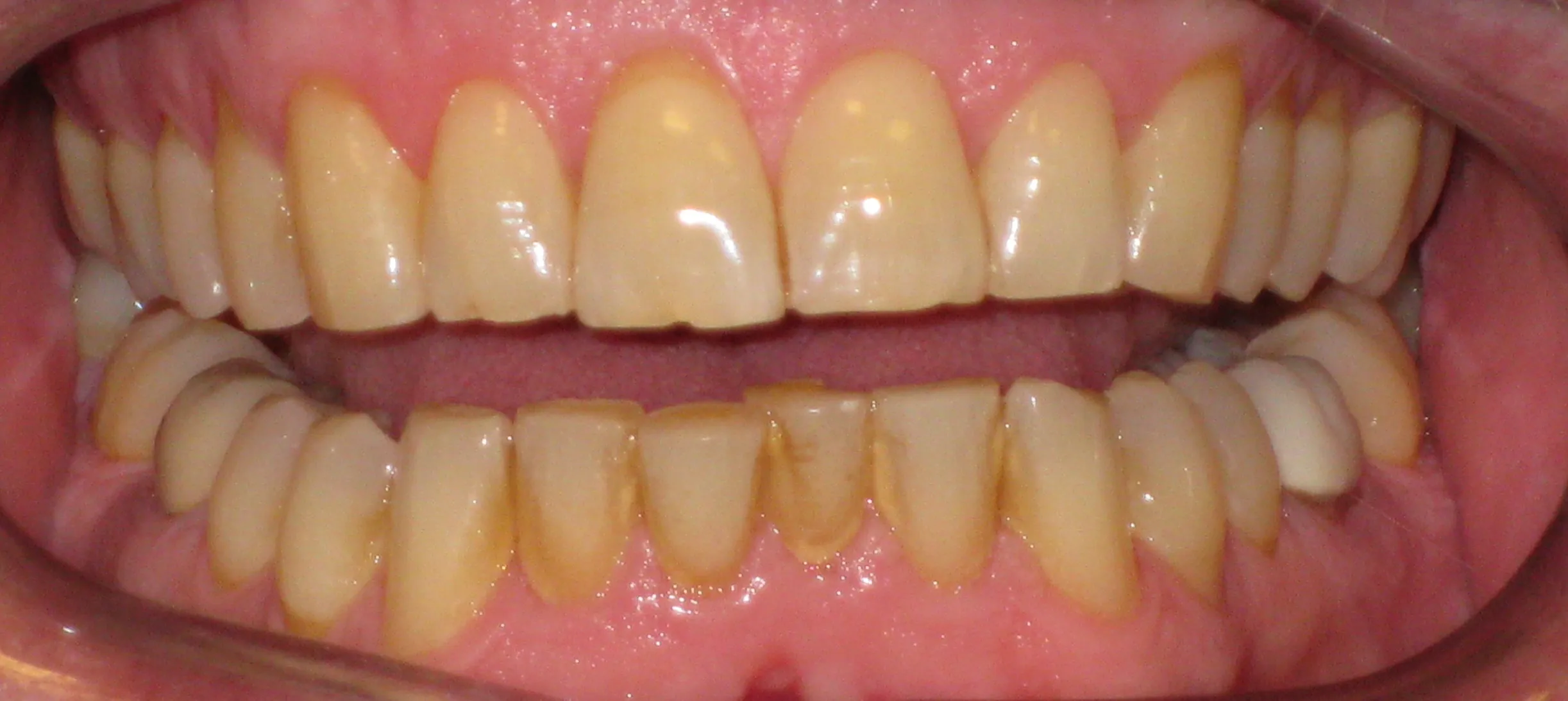 31601 teeth whitening wigan before after