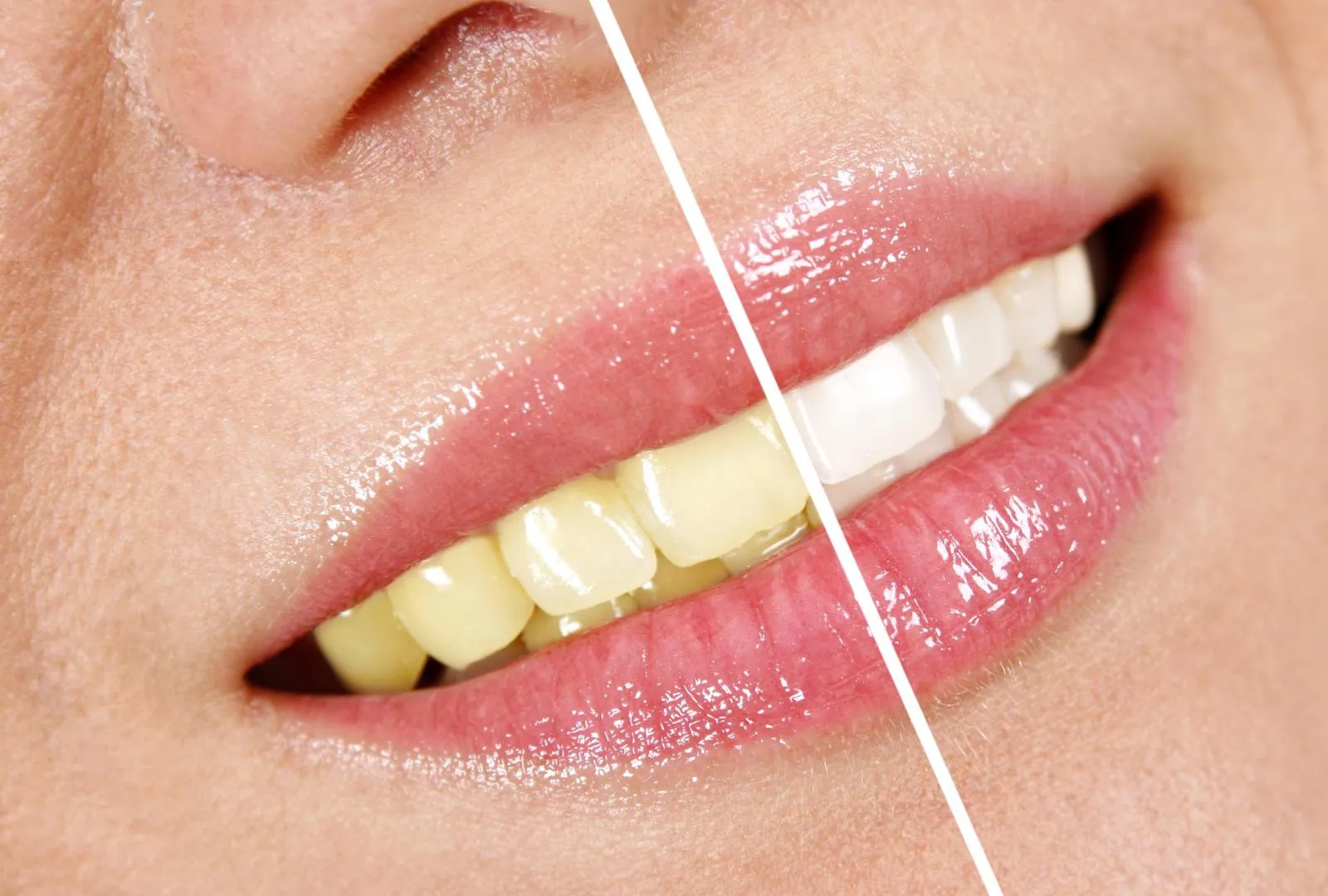 31601 teeth whitening wigan confidence