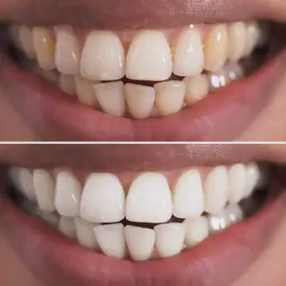 /img/31601-teeth-whitening-wigan-healthy-teeth.webp