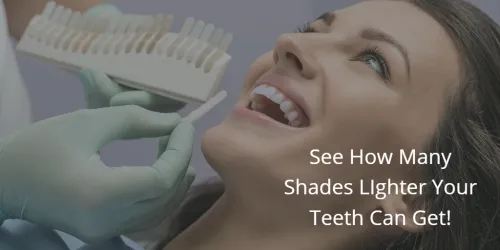 31605 realistic expectations teeth whitening