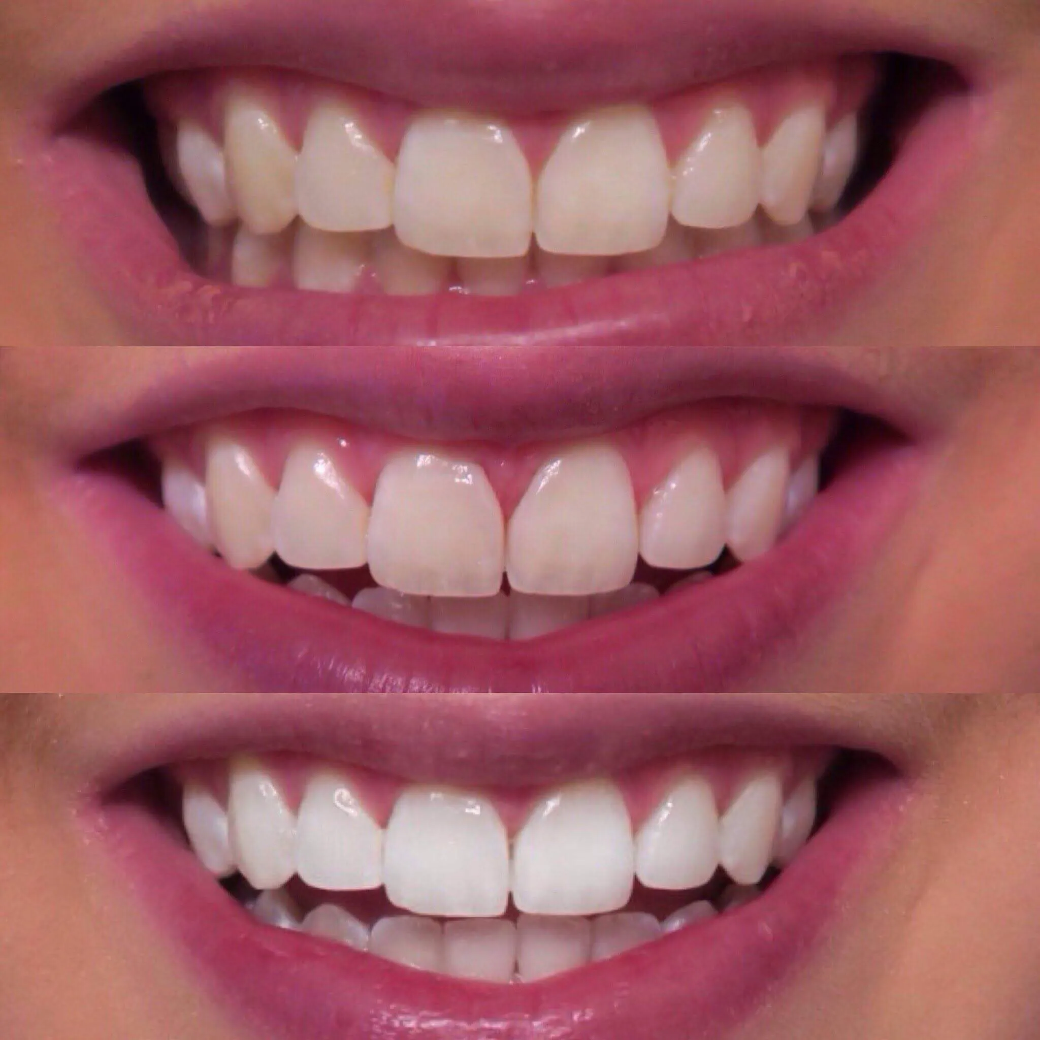 31612 braces damage enamel