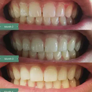 /img/31615-teeth-whitening-alternatives.webp