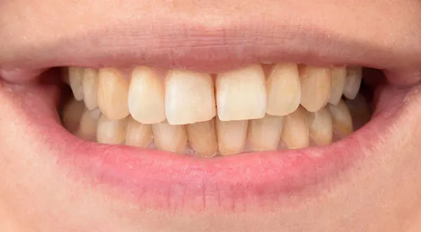 31619 before and after teeth whitening