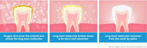 31626 professional teeth whitening