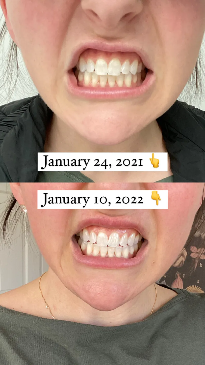 31627 diy teeth whitening ingredients