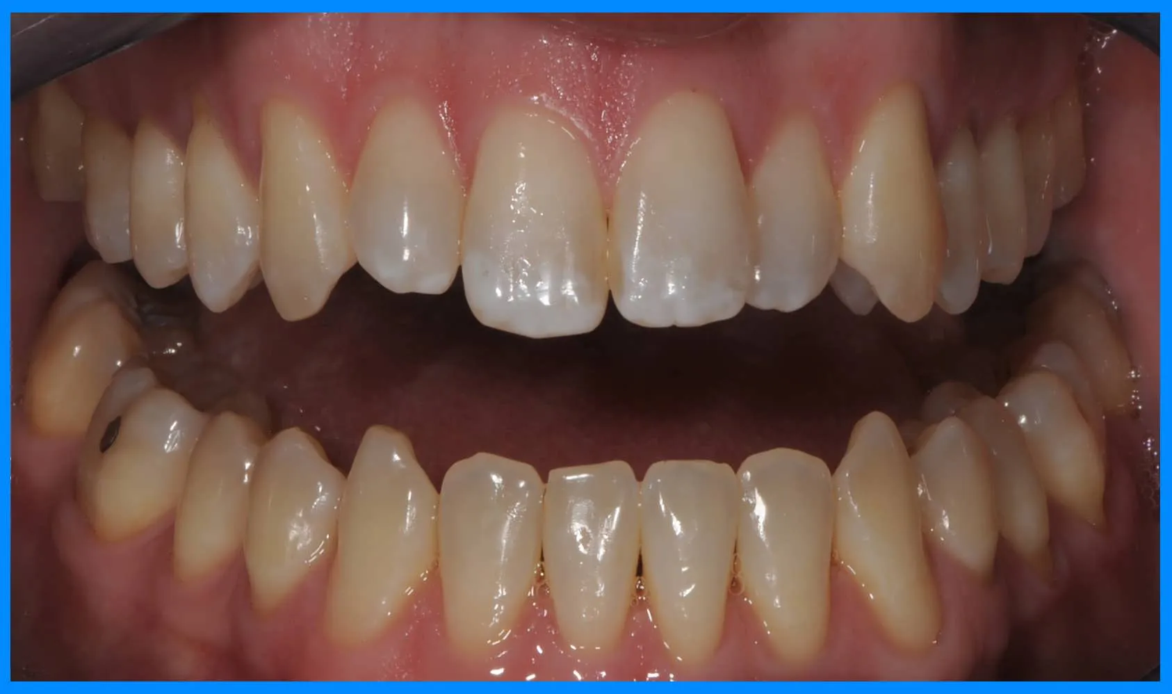 31629 zoom whitening little rock before after