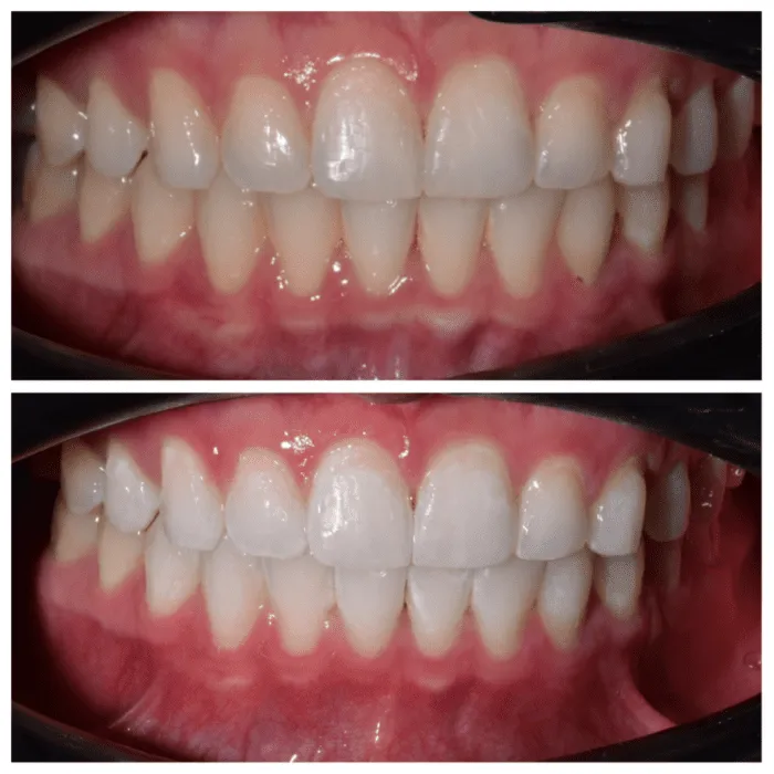 31629 zoom whitening maintenance