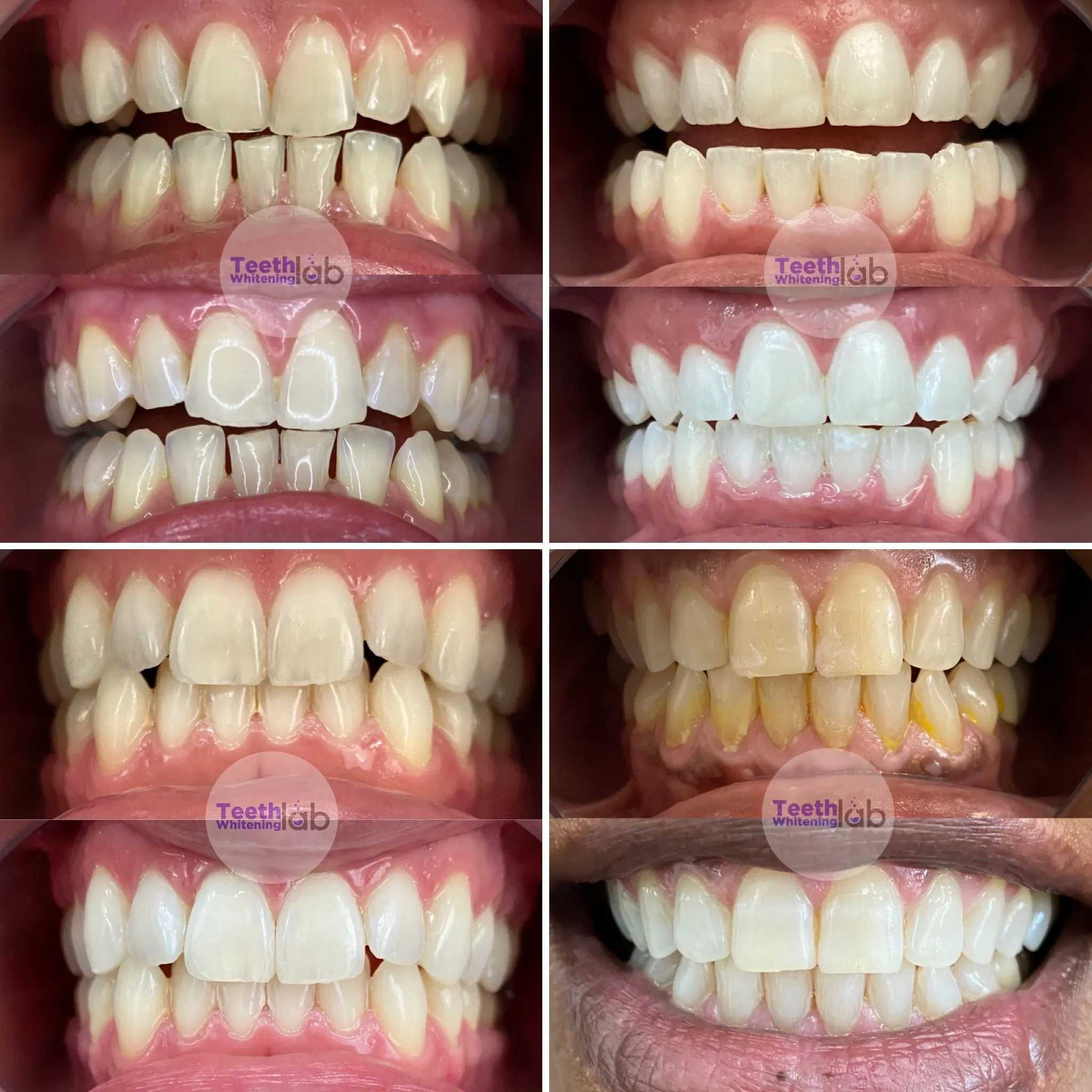 31632 at home teeth whitening