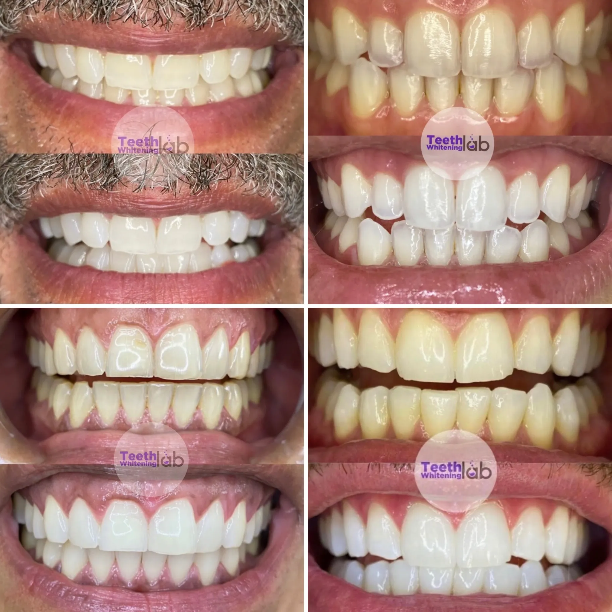 31632 teeth whitening procedure