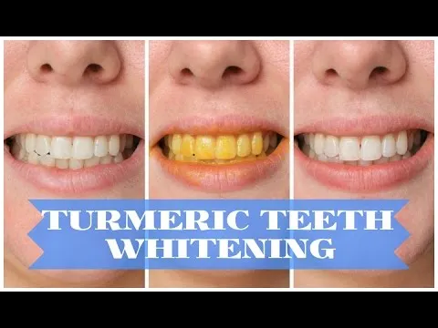 /img/31633-turmeric-teeth-whitening-8.webp