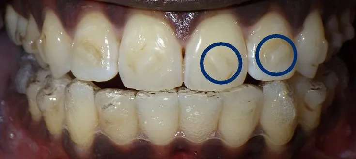 31637 invisalign attachments