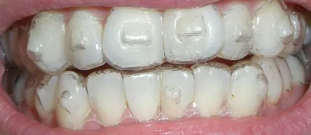 31637 maintaining white teeth