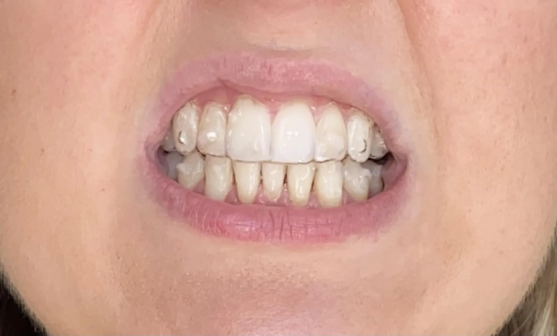 31637 teeth whitening with invisalign