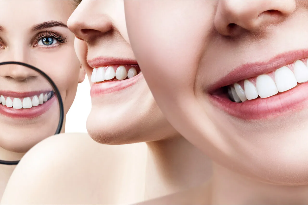 31641 zoom whitening side effects 4