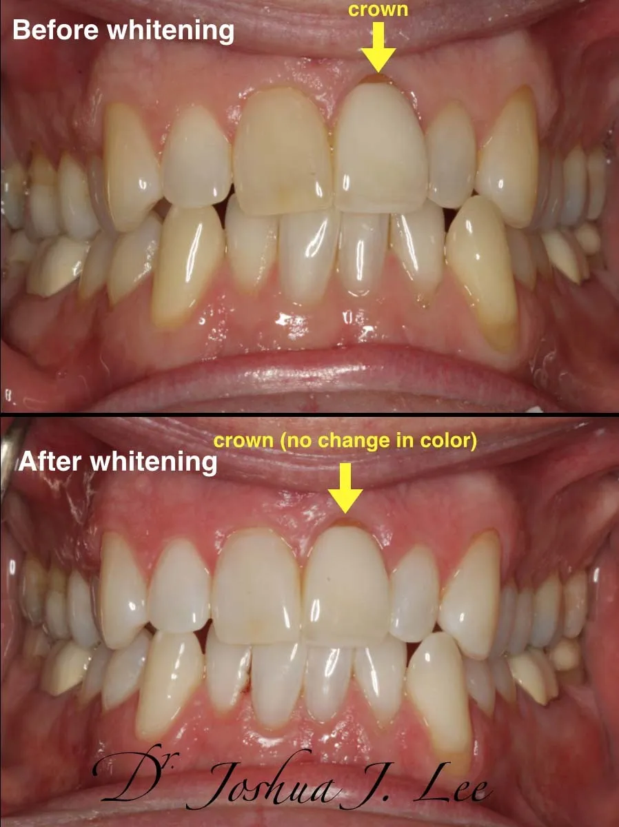 31641 zoom whitening side effects 5