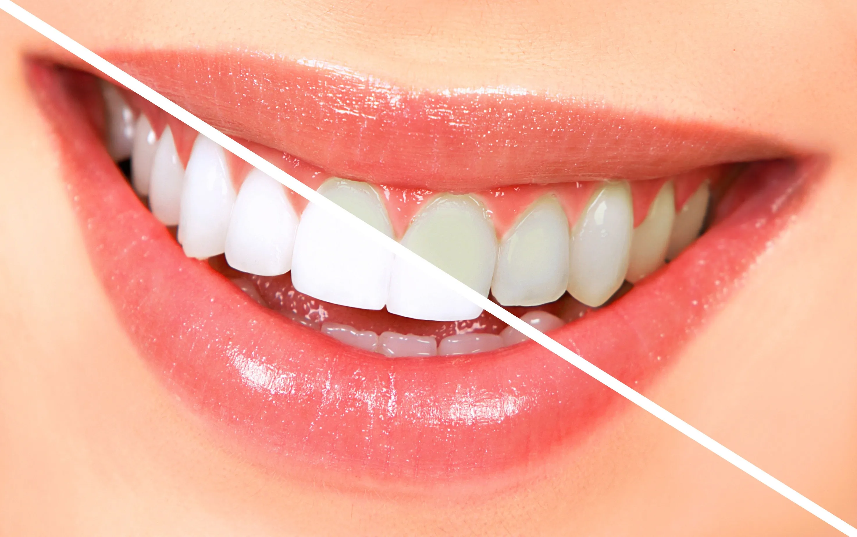 31646 social advantages teeth whitening