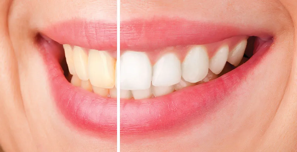 31646 teeth whitening cost analysis