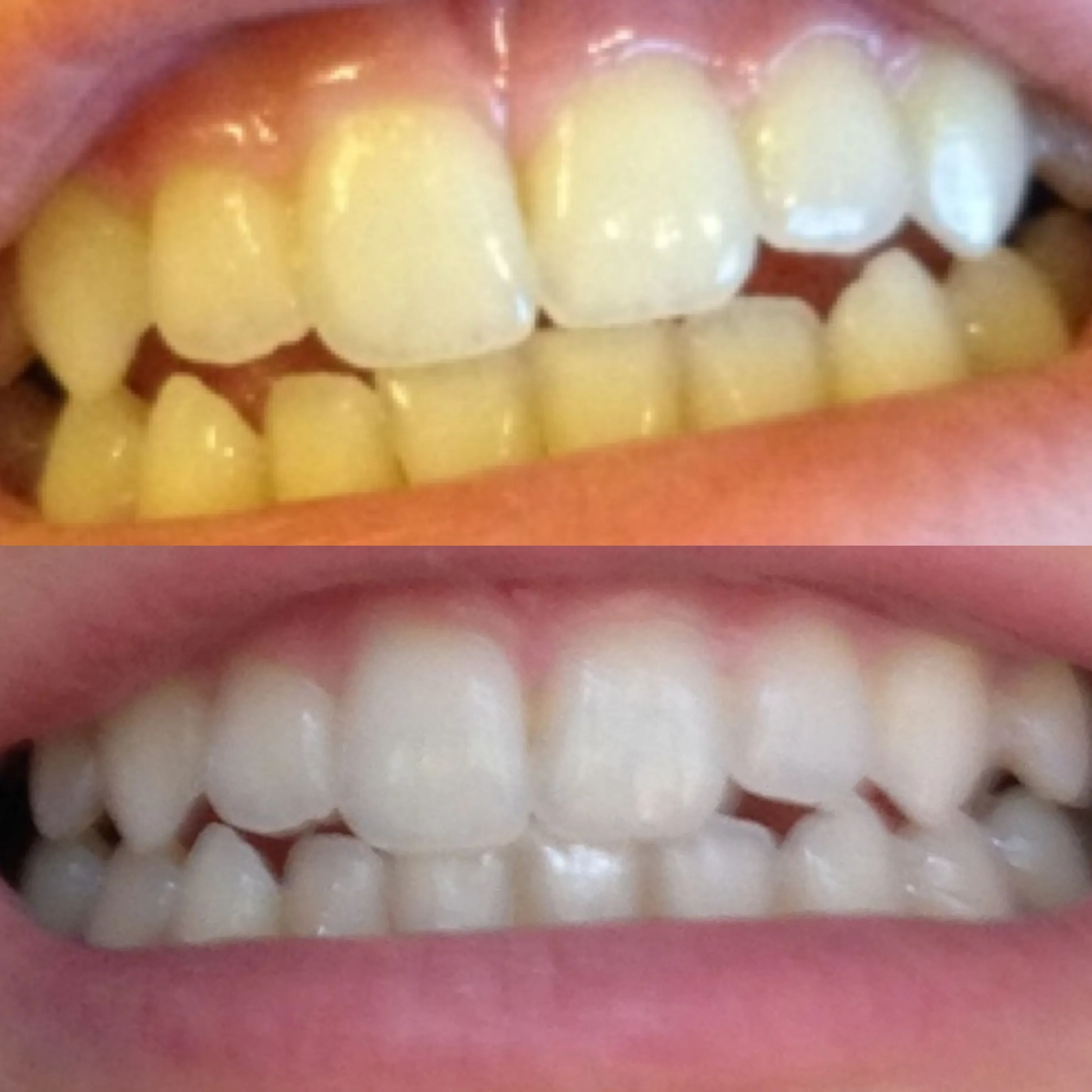 31648 teeth whitening stl options