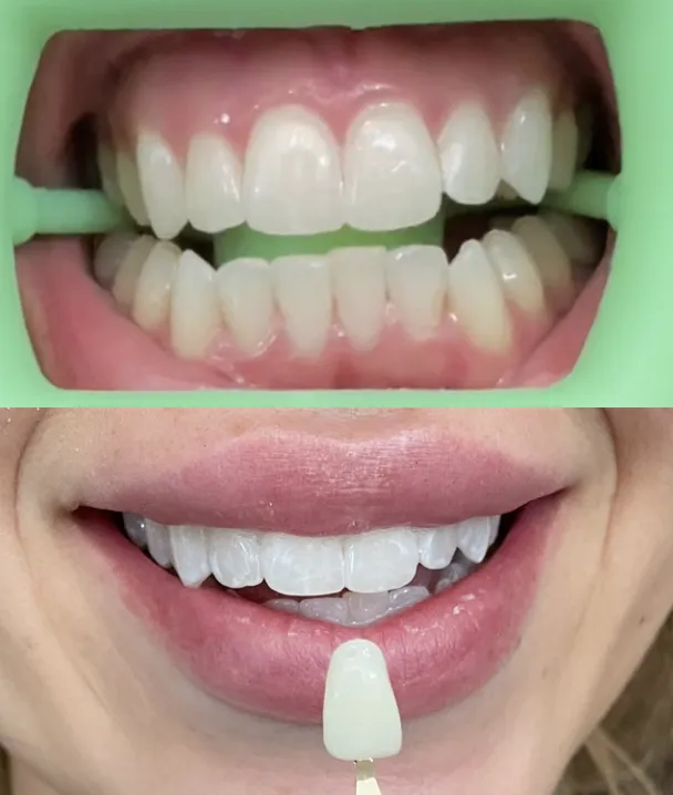 31653 at home teeth whitening