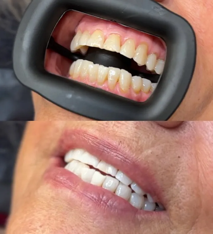 31653 teeth discoloration causes