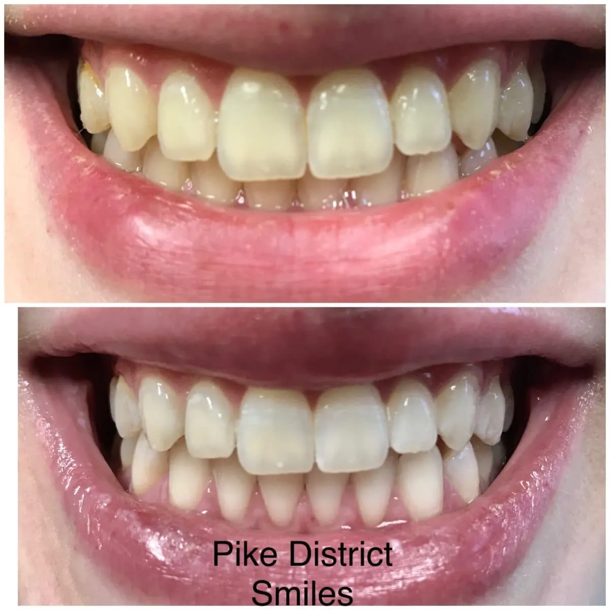 31655 teeth whitening rockville md oral hygiene