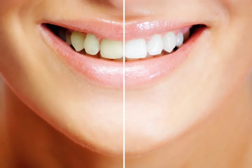 /img/31655-teeth-whitening-rockville-md-professional.webp
