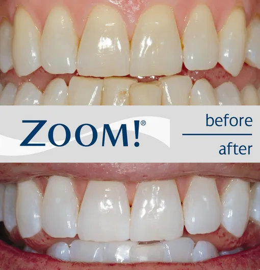 31663 take home whitening kits