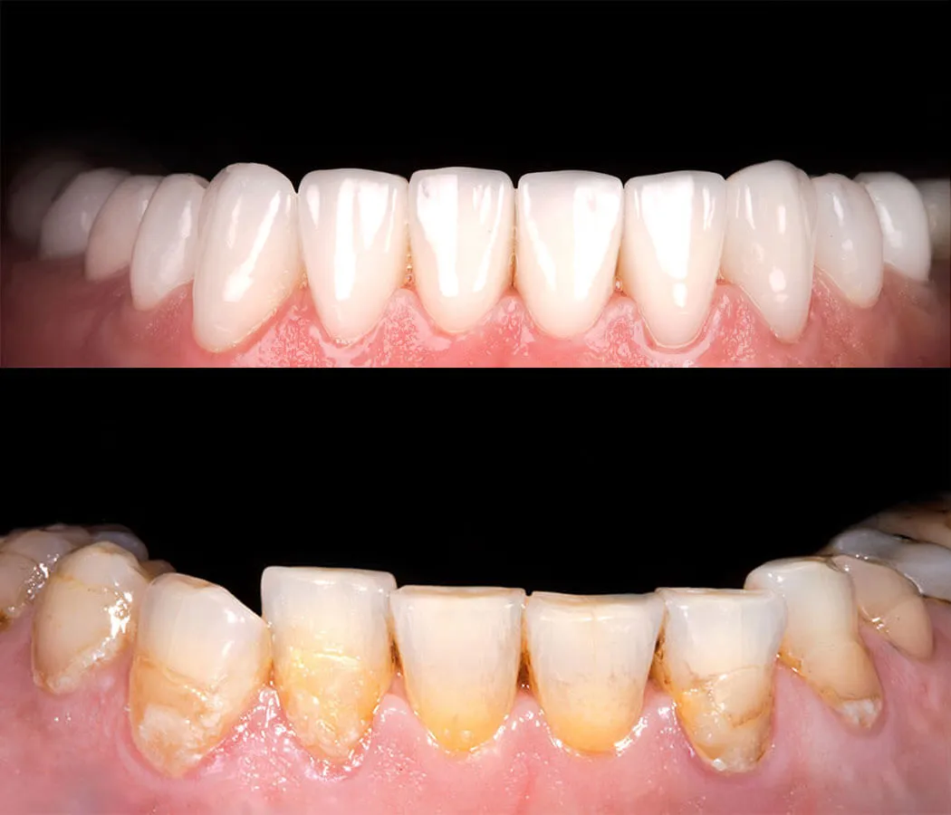 31669 tooth whitening veneers before after