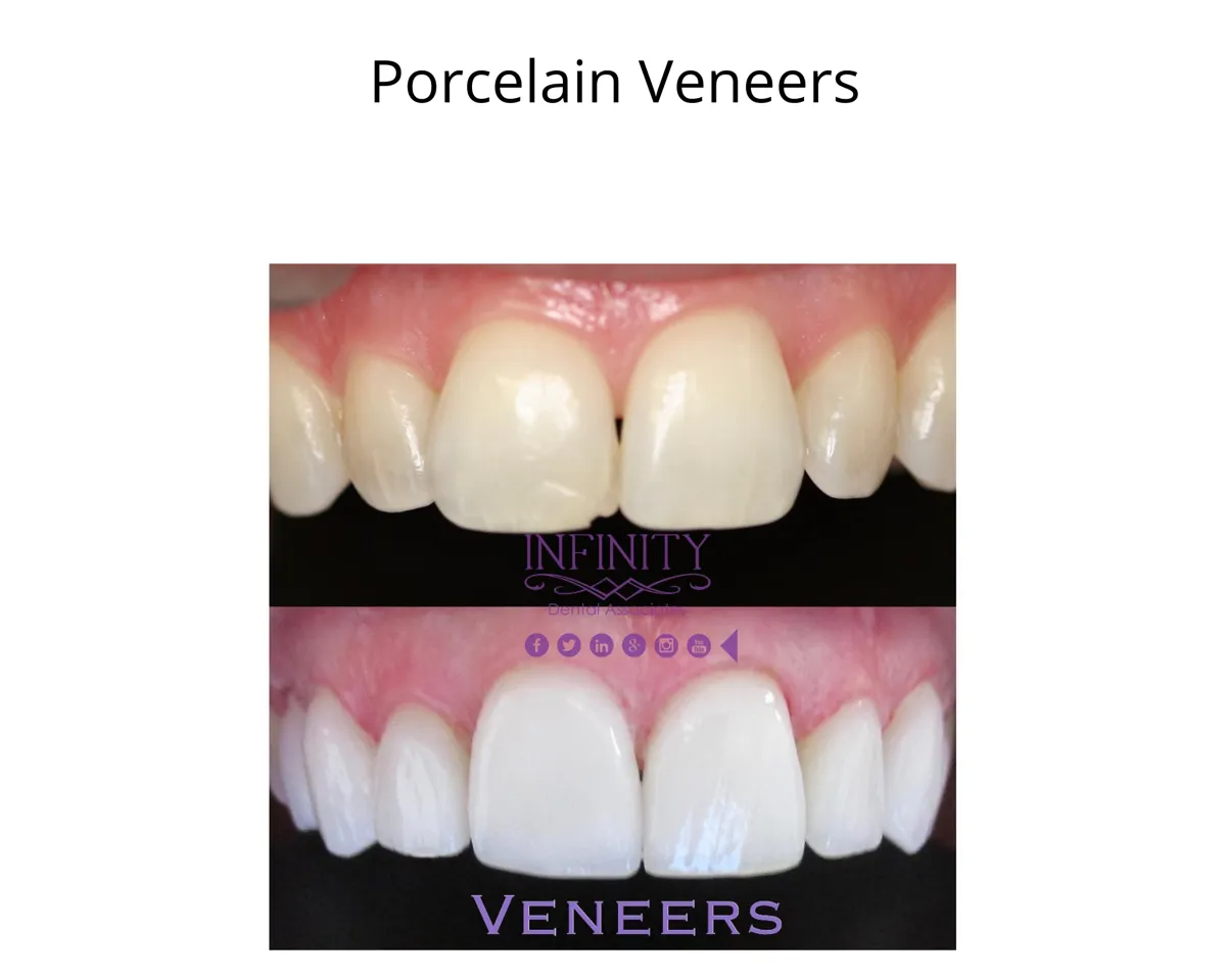 31669 types of veneers