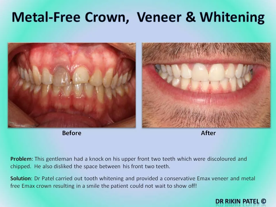 31669 veneers aftercare