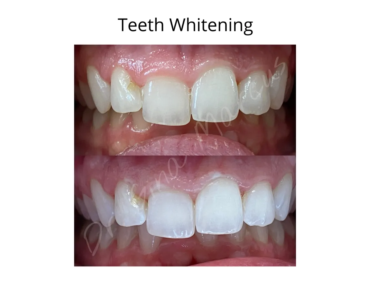 31669 veneers procedure