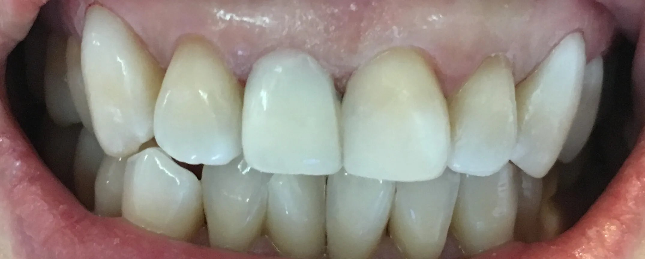 31669 veneers smile