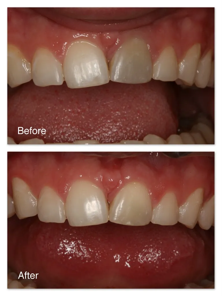 31671 at home teeth whitening kit