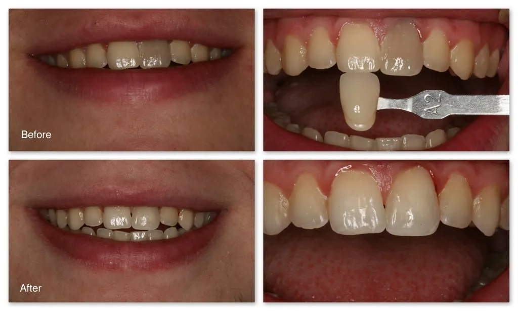 31671 professional teeth whitening