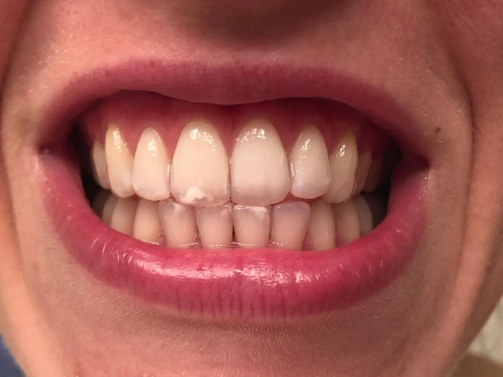 31673 lux whitening pen comparison