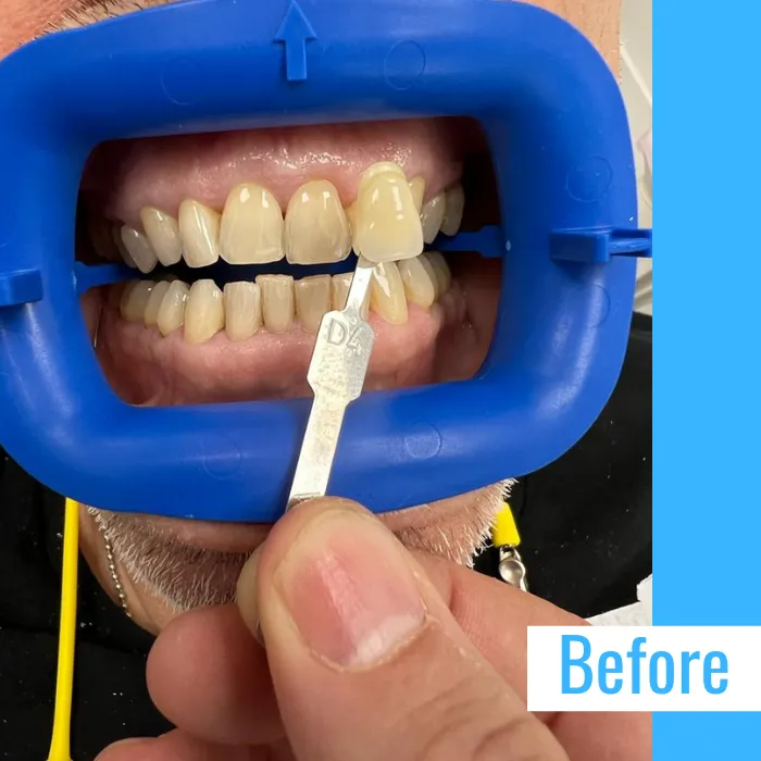 31688 maintaining whitened smile