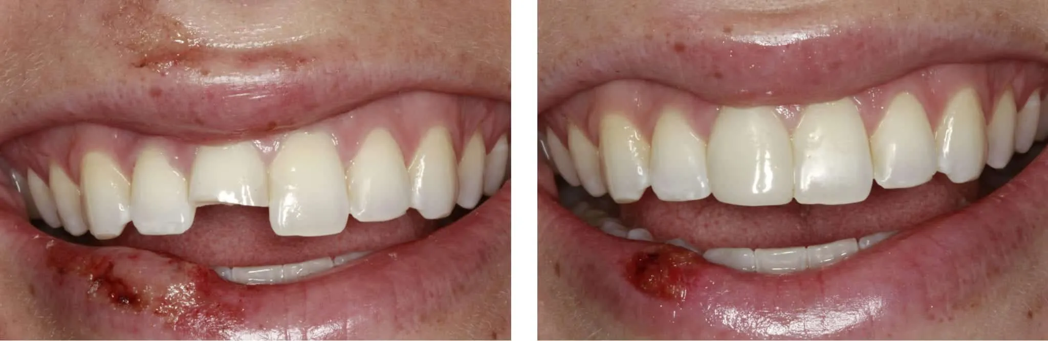 31688 professional teeth whitening los angeles