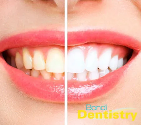 31691 in office teeth whitening