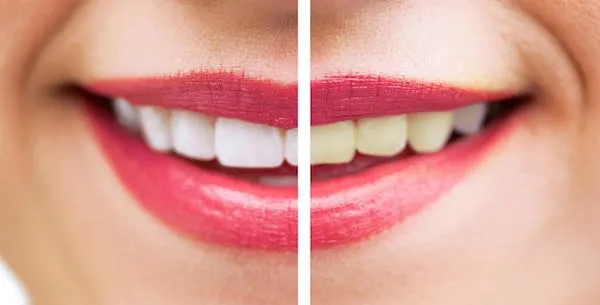 31691 teeth whitening bondi beach